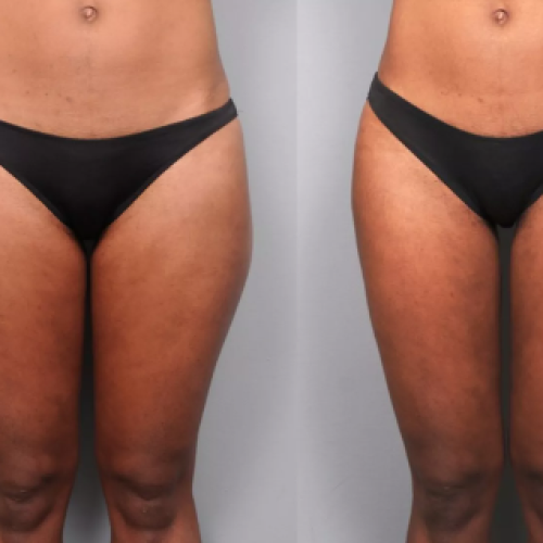 Liposucción Láser Foto antes/después